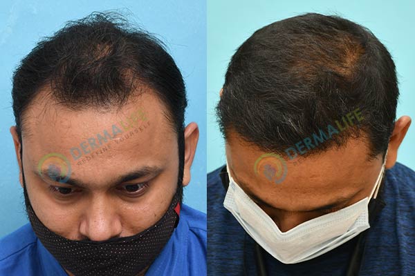 Before and After Results of Hair Transplant for Norwood Grade 2