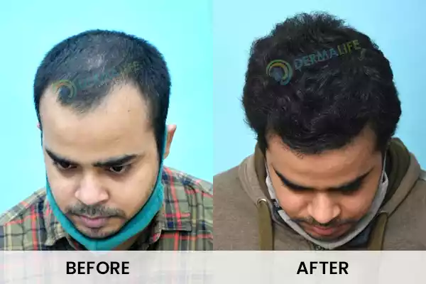Before and After Results of Hair Transplant for Norwood Grade 2