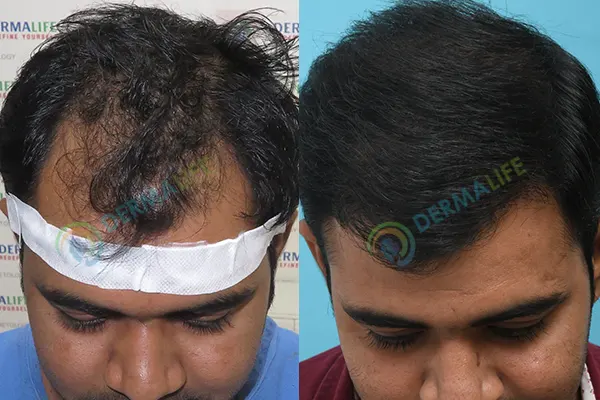 Before and After Results of Hair Transplant for Norwood Grade 3