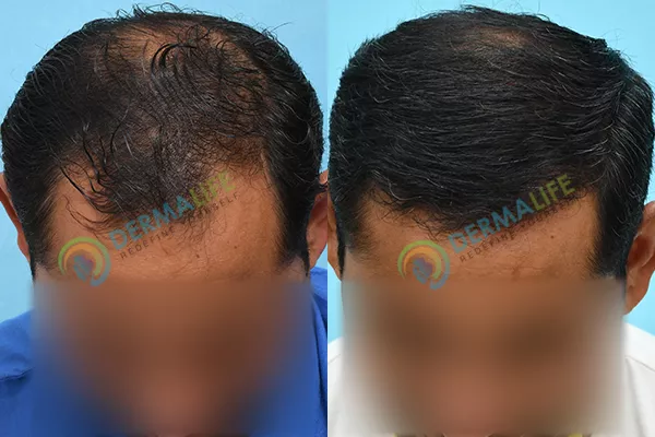 Before and After Results of Hair Transplant for Norwood Grade 4