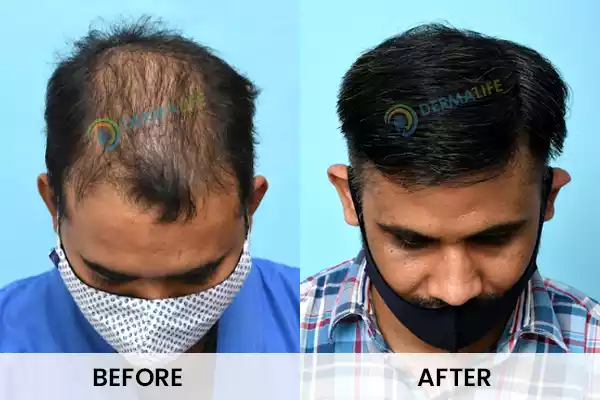 Before and After Results of Hair Transplant for Norwood Grade 4
