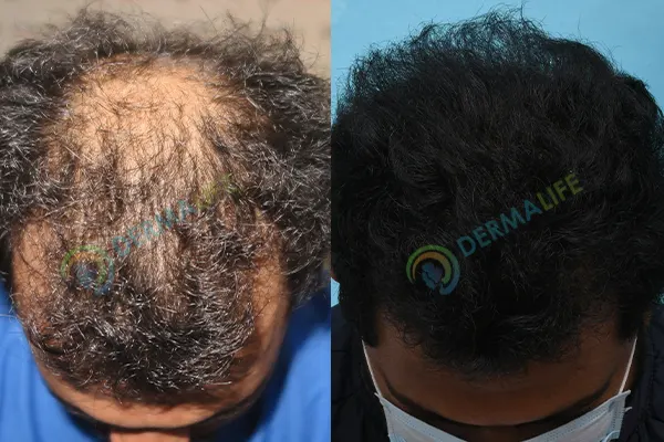 Before and After Results of Hair Transplant for Norwood Grade 5