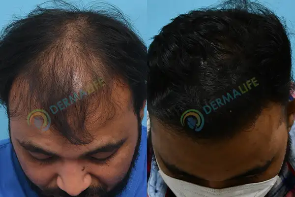 Before and After Results of Hair Transplant for Norwood Grade 5