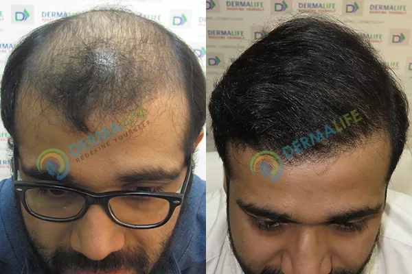 Before and After Results of Hair Transplant for Norwood Grade 6