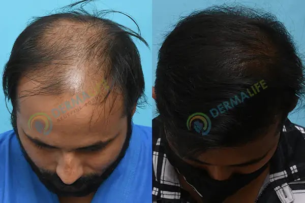 Before and After Results of Hair Transplant for Norwood Grade 6