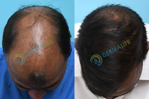Before and After Results of Hair Transplant for Norwood Grade 7