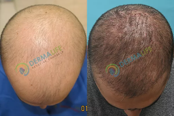 Before and After Results of Hair Transplant for Norwood Grade 7
