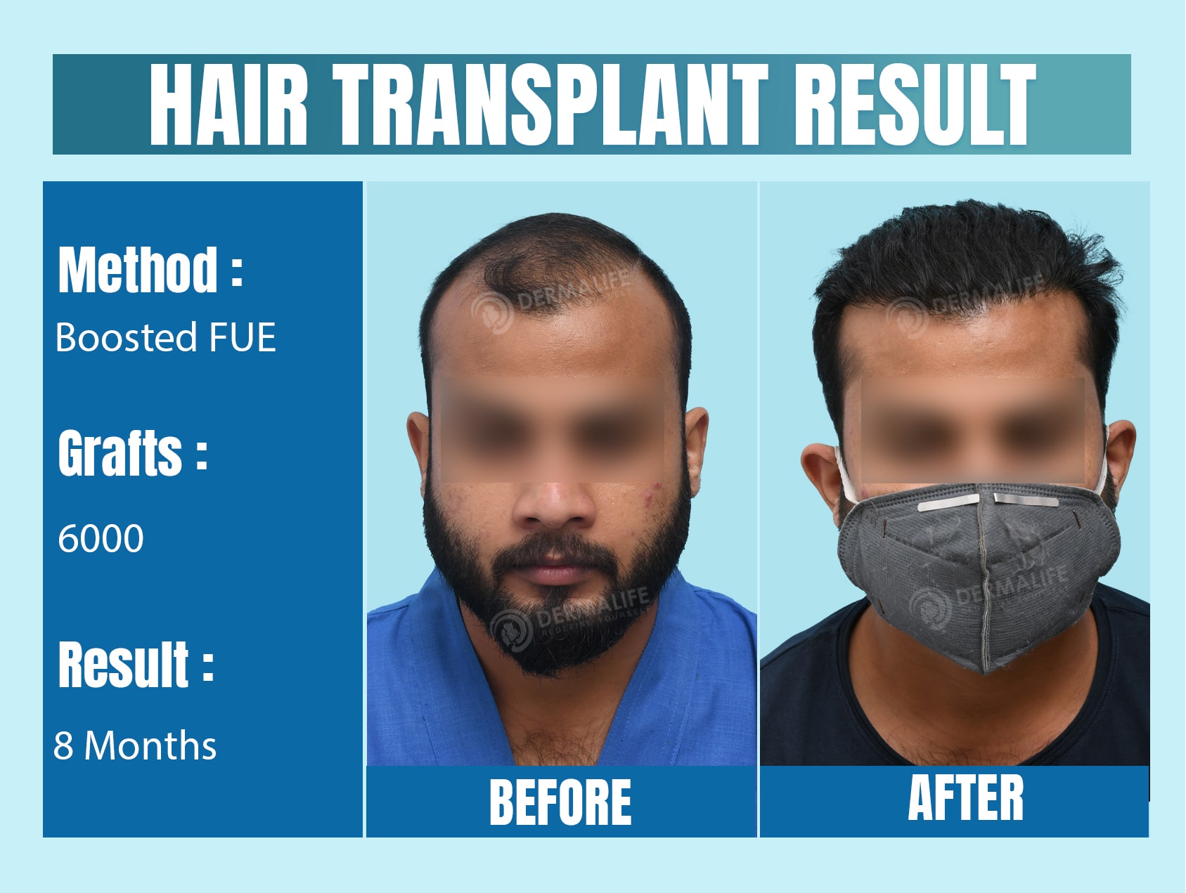 top 10 hair transplant clinic in delhi