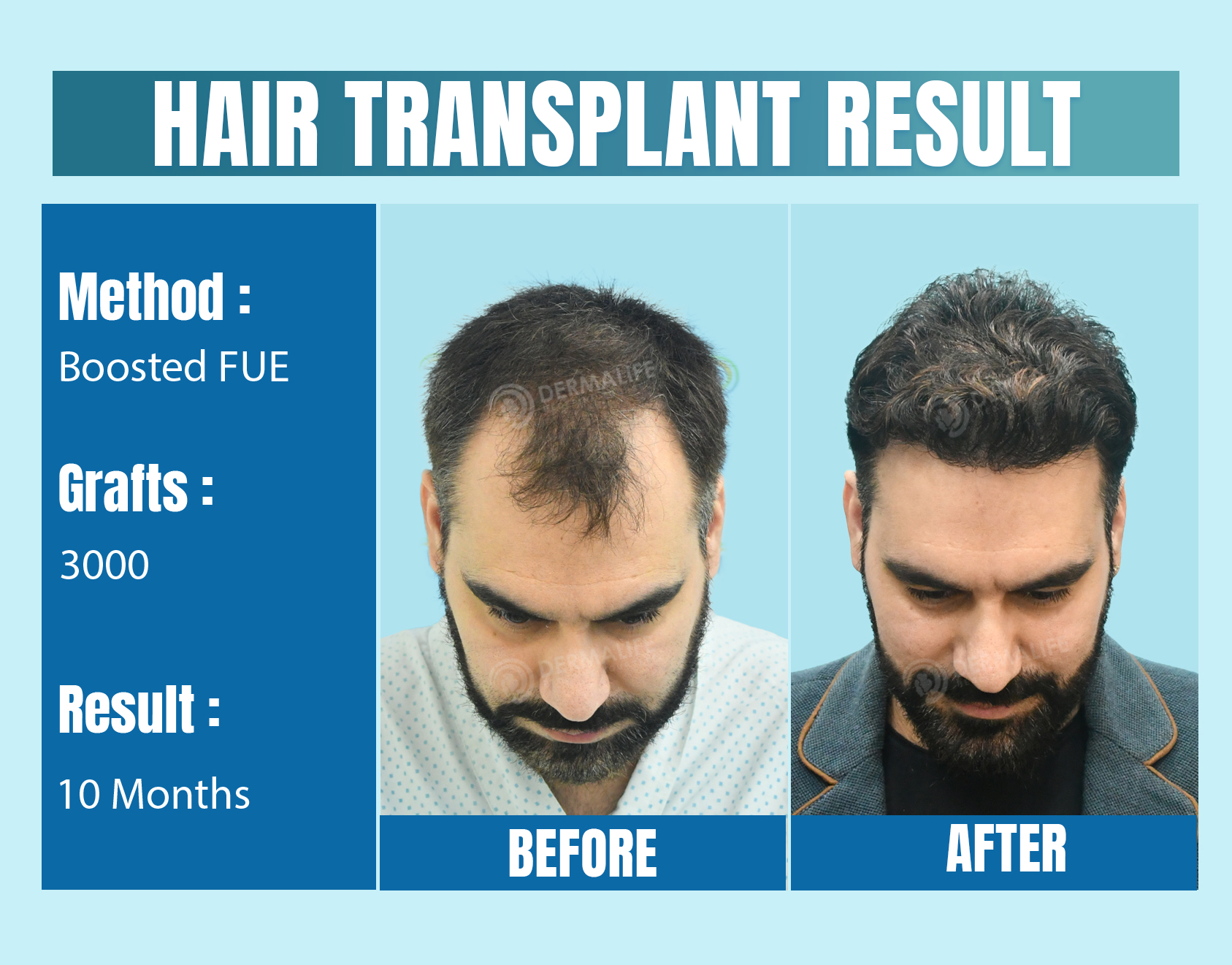top 5 Hair Transplant clinic in Delhi