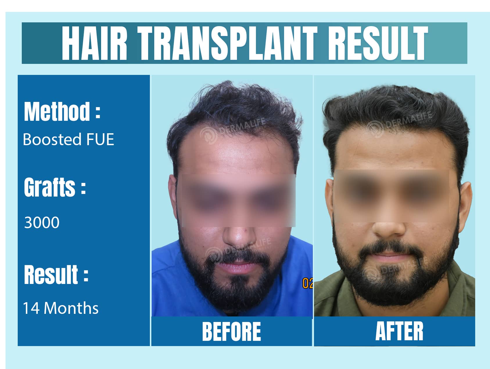 top 5 hair transplant clinics in Delhi