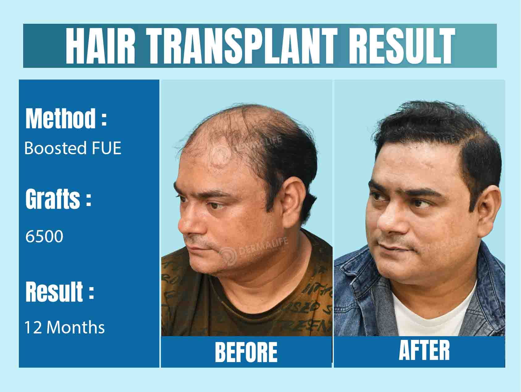 Top celebrity hair transplant doctors in India