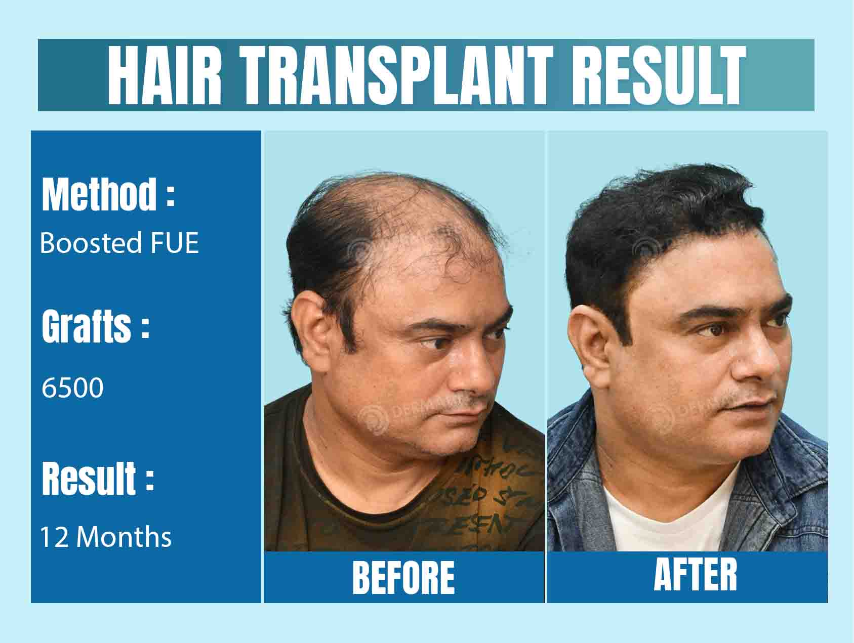 Top celebrity hair transplant doctors in India