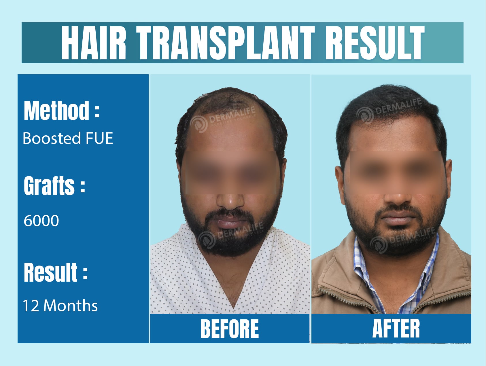 top hair transplants in Delhi