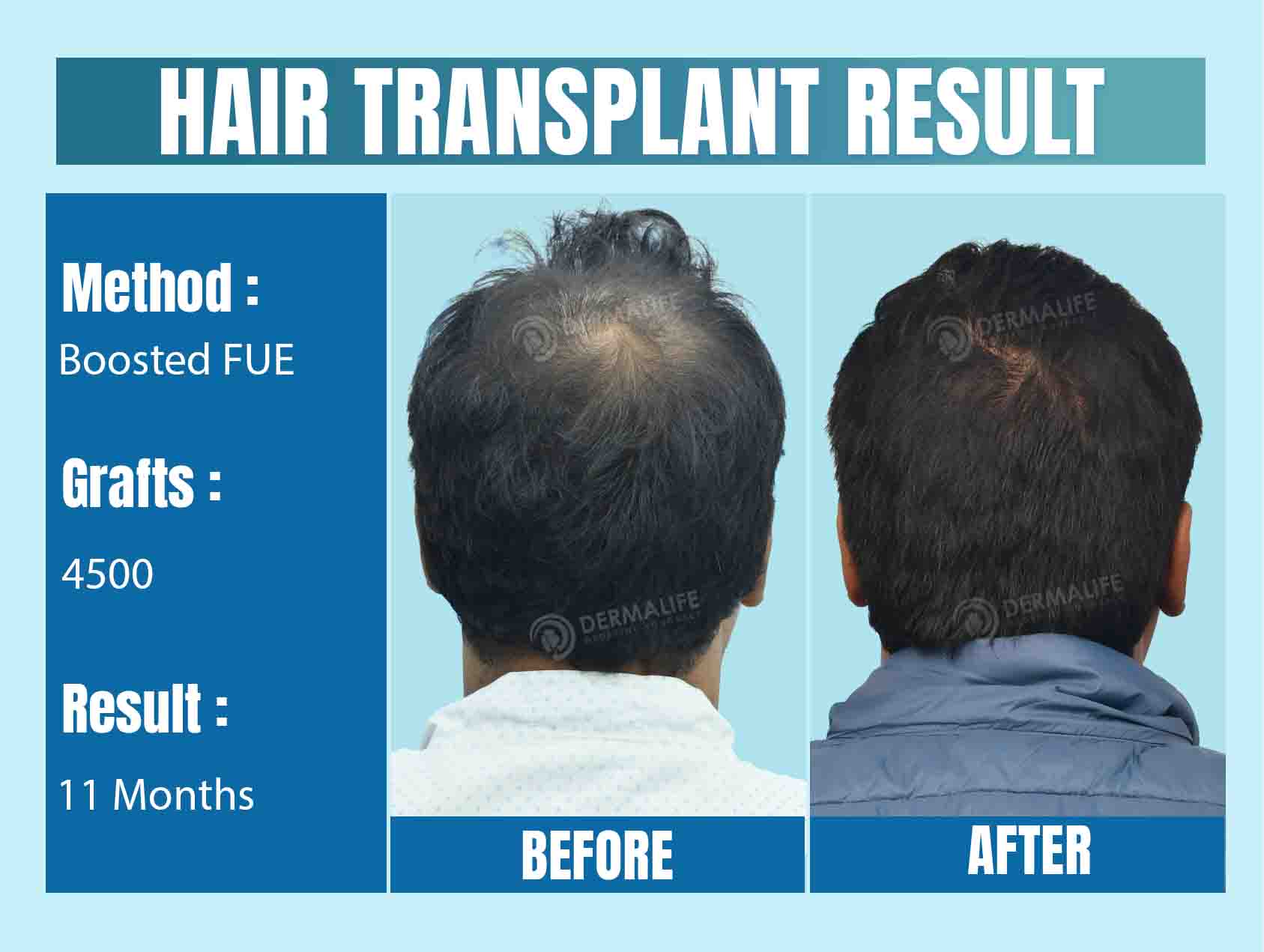 top hair transplant surgeon in Delhi
