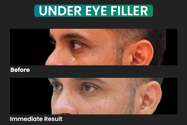 under eye filler cost in delhi