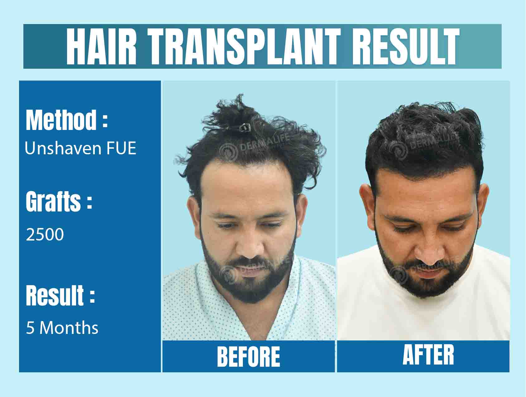 unshaven fue hair transplant cost in Delhi