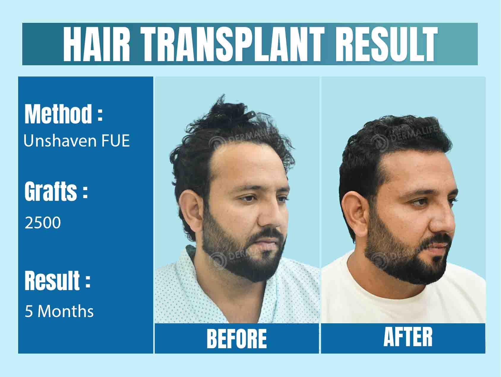 unshaven fue hair transplant cost in Delhi