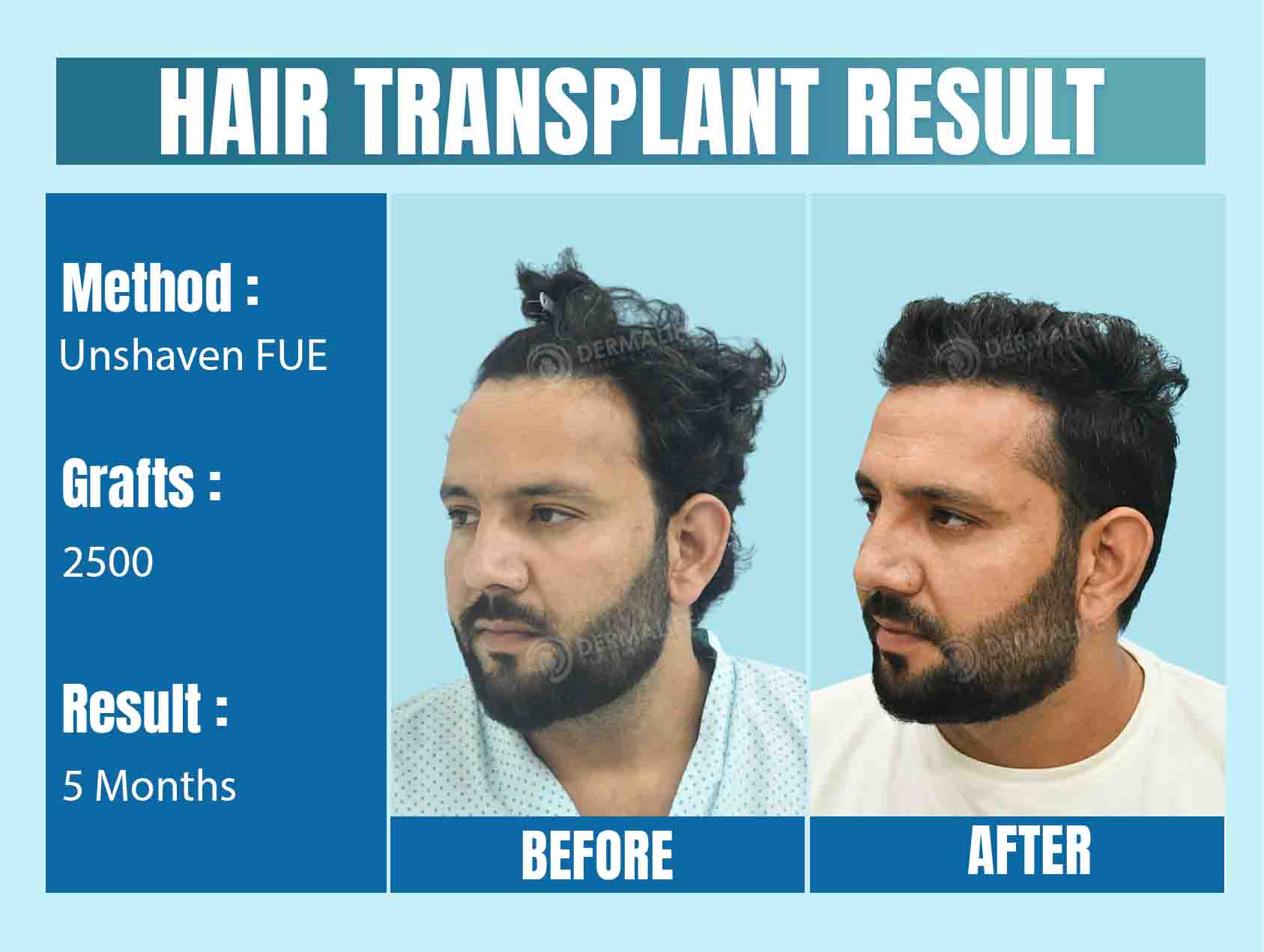 unshaven fue hair transplant cost in Delhi