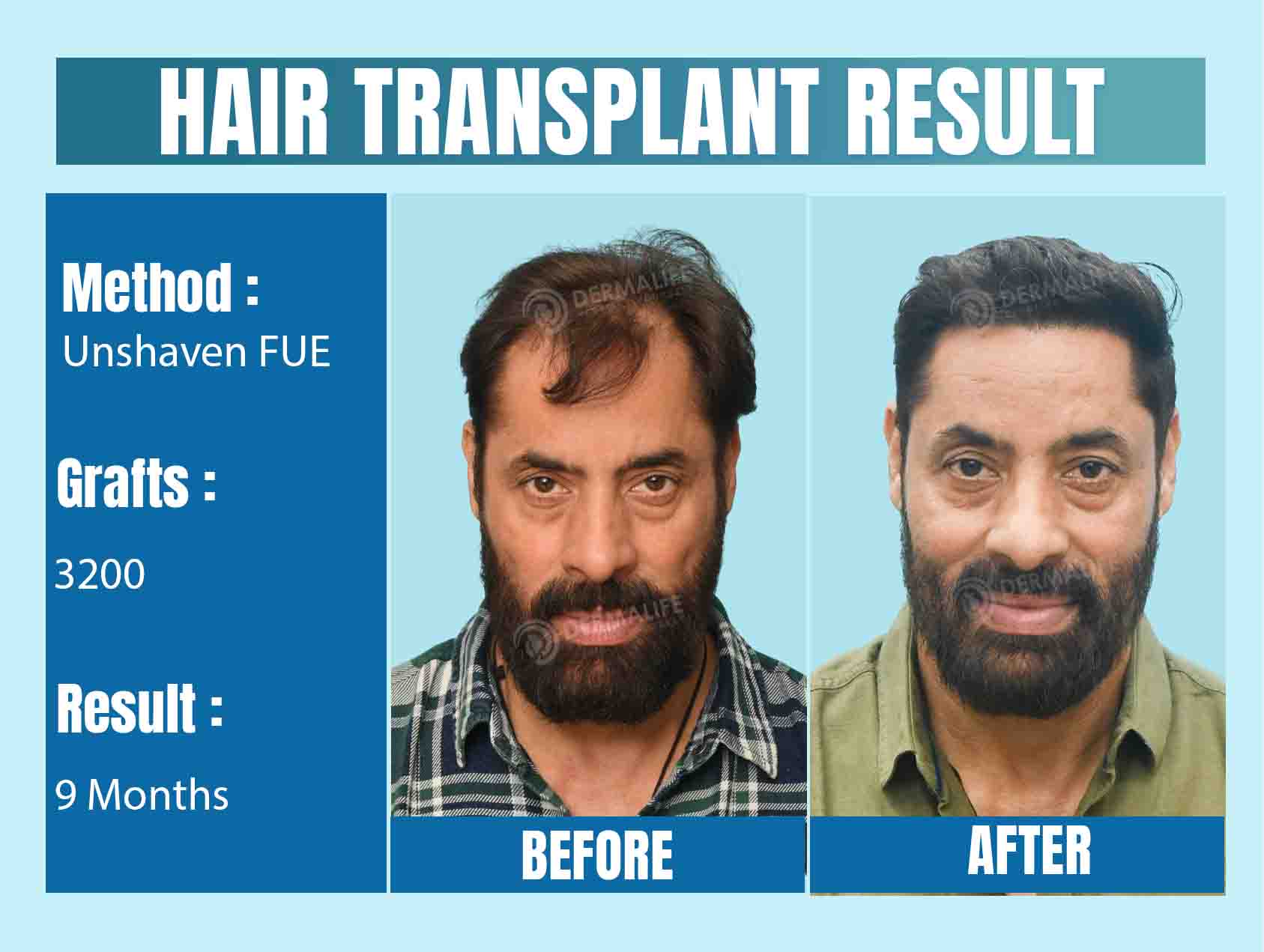 hair Transplant Before & After