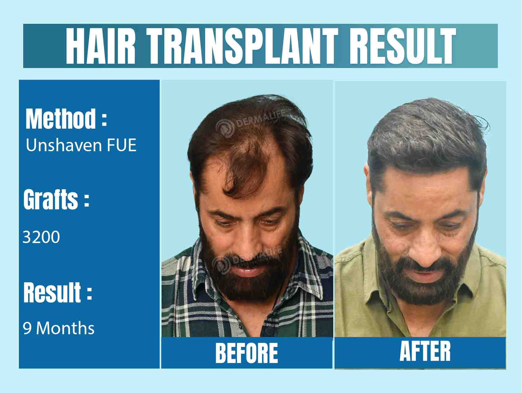 Unshaven FUE hair transplant Cost in India