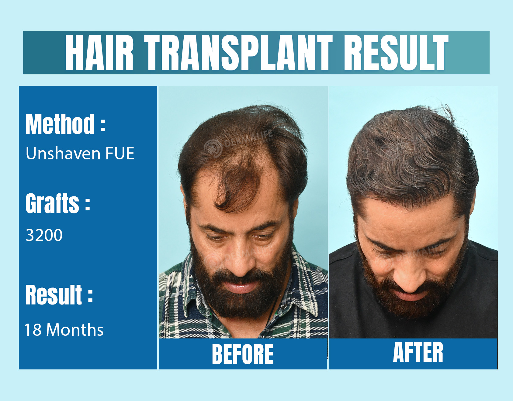 Unshaven FUE hair transplant cost in India