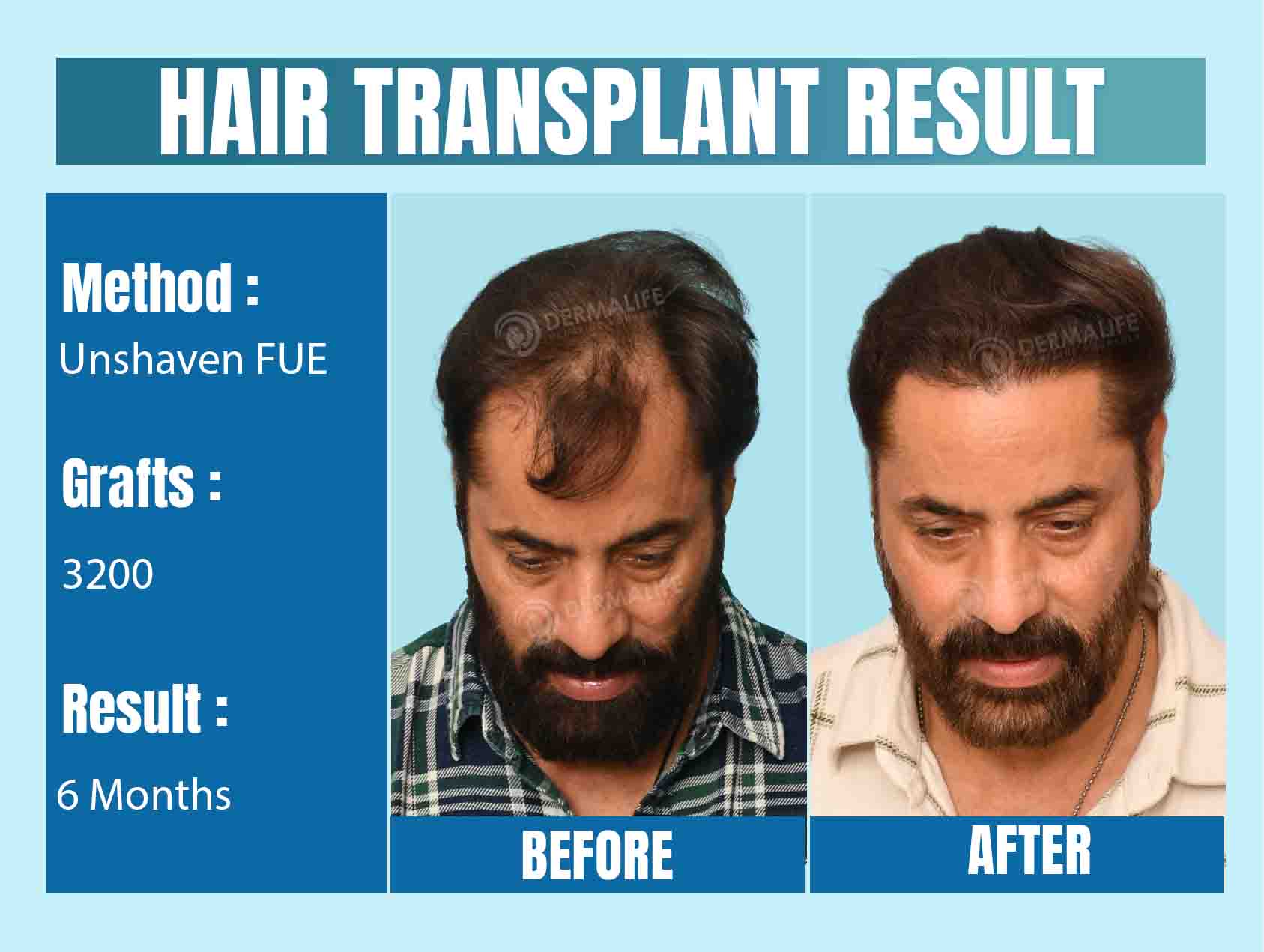 unshaven fue hair transplant in Delhi
