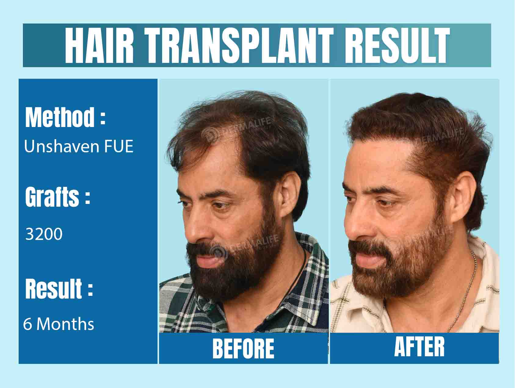 Celebrity Hair Transplant Before And After