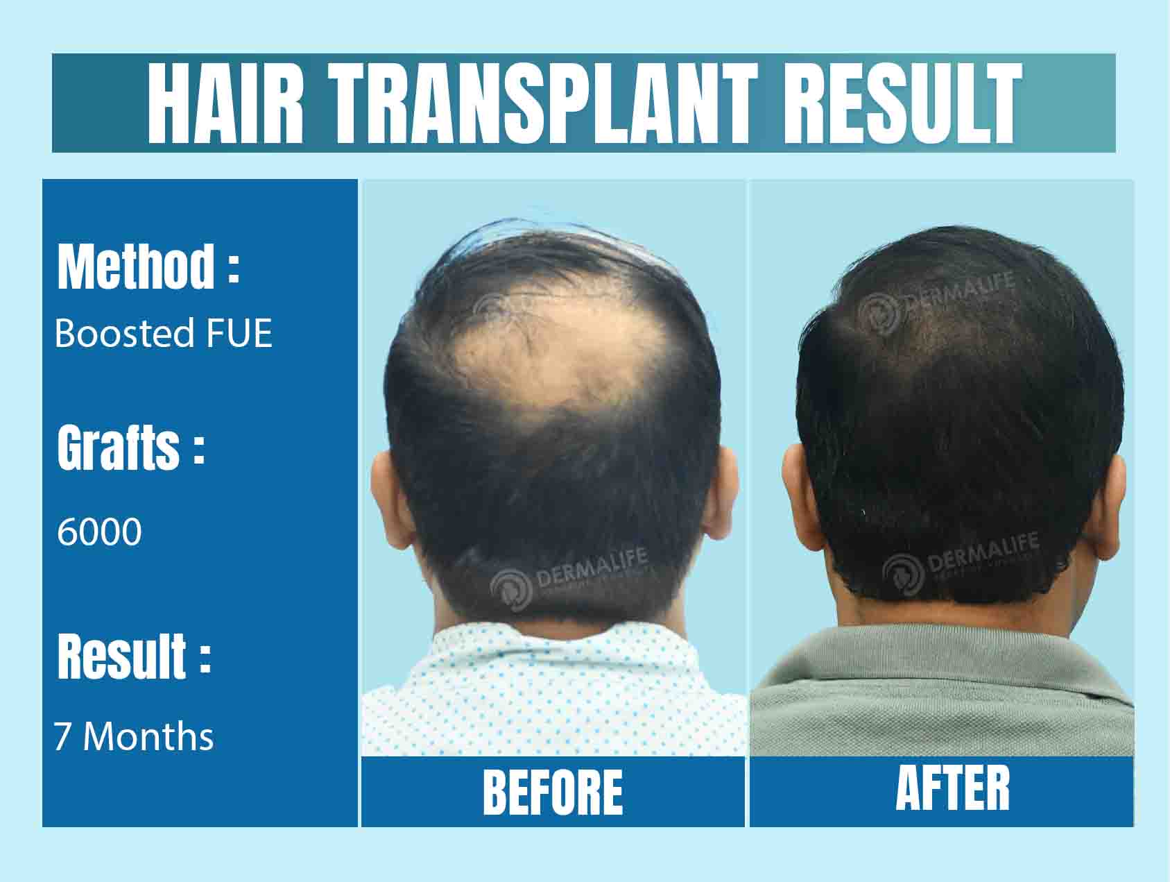 world's best hair transplant clinic in India