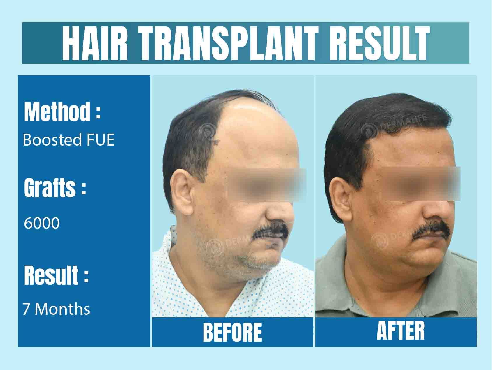 world's best hair transplant clinic in India