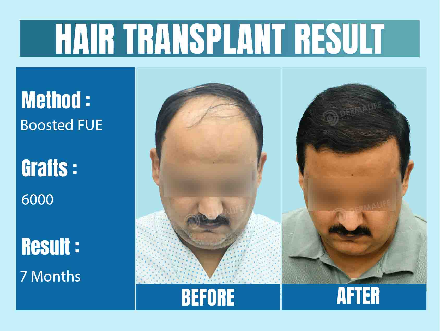 world's best hair transplant clinic in India