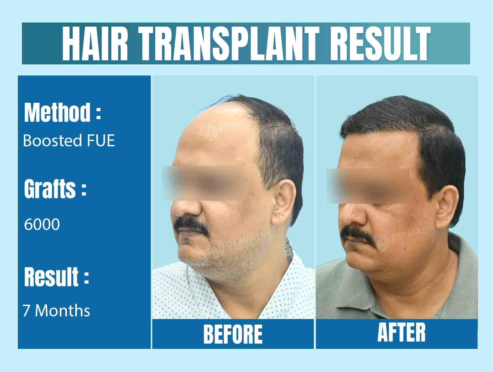 world's best hair transplant clinic in India